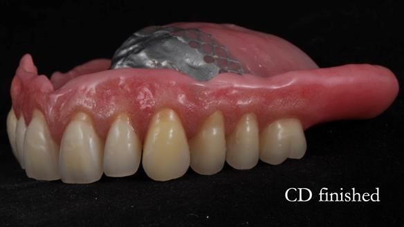 Finlay's Newsletter 62 provision of extractions and metal based complete dentures for Rafique