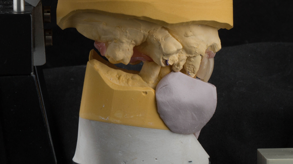 Figure 27 UR21 UL2 teeth removed from cast and UR21 UL12 teeth arranged to pre-drifted positions