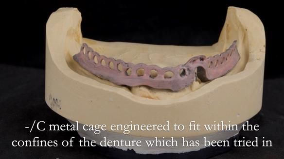 Managing poor implant positioning with complete dentures and Locator attachments - full protocol Newsletter 41