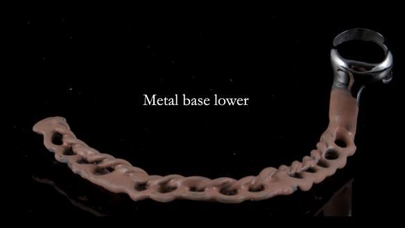 Finlay's Newsletter 59 Ultra hard partial dentures made for Gill