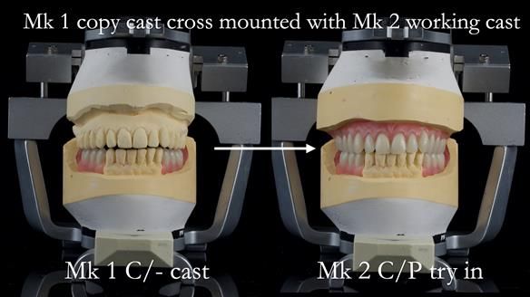 Newsletter 52 Managing Jo’s failing dentition with extractions and Mk 1/Mk 2 complete upper dentures and lower partial dentures FULL PROTOCOL