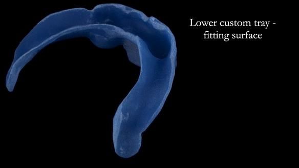 Newsletter 57 showcases the making and fitting process of implant-supported complete dentures for Alisdair