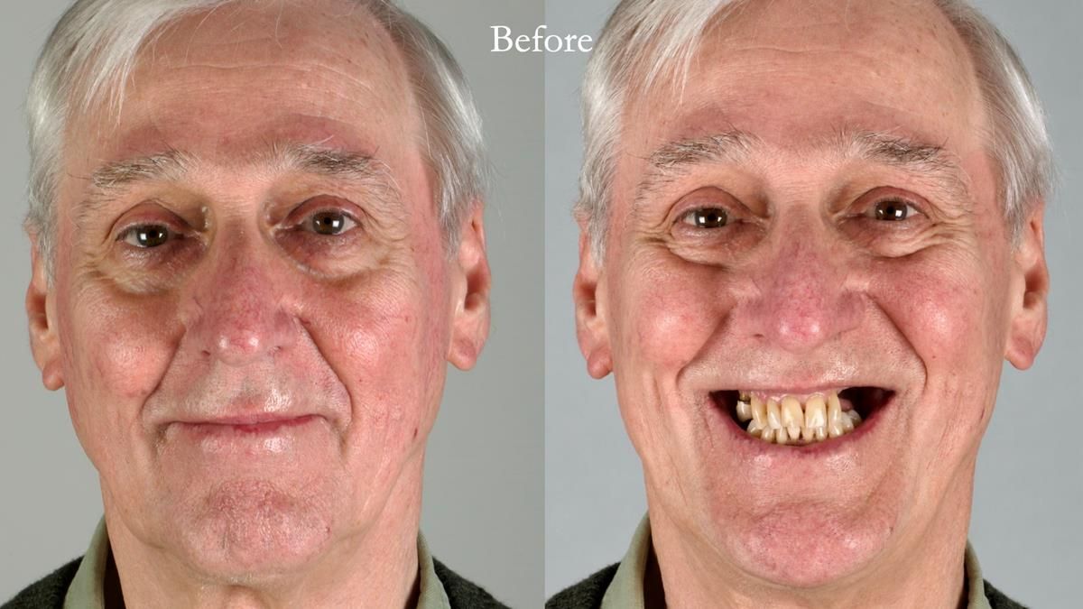 Newsletter 89 – Simon: A Challenging Kennedy Class II Division 1 Upper CoCr Partial Denture with a High Smile Line