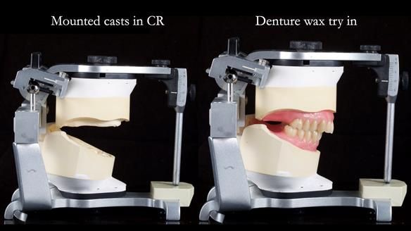 Newsletter 80 - Gordon’s dentures: the one case in 1,000 where my technique failed