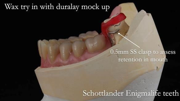 Finlay's Newsletter 59 Ultra hard partial dentures made for Gill