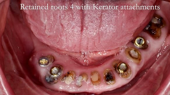 Newsletter 44 - extreme removable prosthodontics – engineering a super-strong and ultra-thin over denture