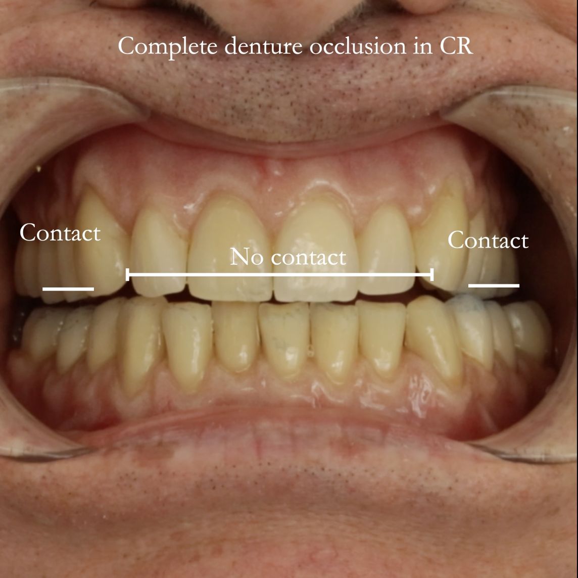 Biting and new complete dentures – the sandwich filling