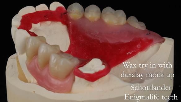 Finlay's Newsletter 60 Sylvia's upper Kennedy Class 2 Mod 1 metal based upper RPD