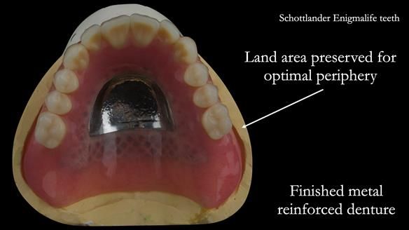 Finished metal reinforced upper denture finished to the land area of the model for optimal polished surfaces