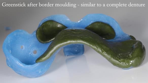 Finlay's Newsletter 58 Gasket upper partial denture for Zoe