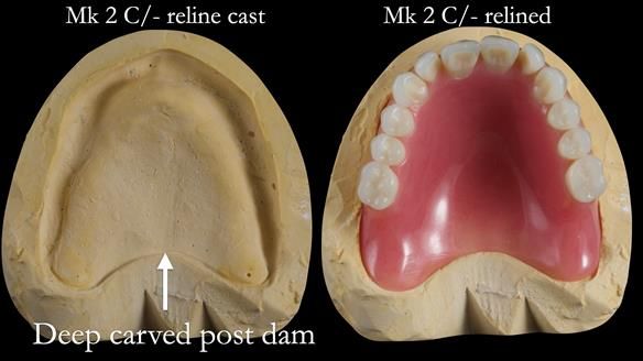 Replacing Madeline’s Complete denture FULL PROTOCOL