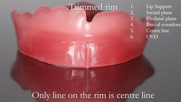 Newsletter 54 case presentation upper complete denture and lower Scandinavian designed hygienic partial denture for David