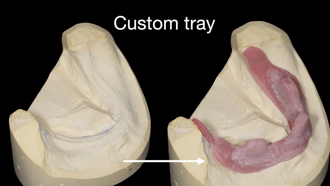 Custom tray design to maximise suction and stability for a lower complete denture. Step by step video: