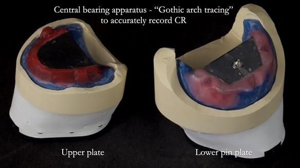 Newsletter 83: Sheila’s Complete Denture Success