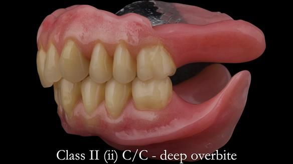 Complete denture Class II div 2 deep overbite Newsletter 39