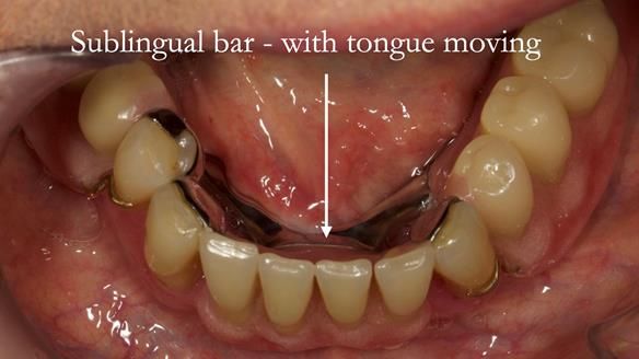 Finlay's Case Study Newsletter 40 - Immediate Mk 1 RPD to Definitive Mk 2 RPD - full protocol