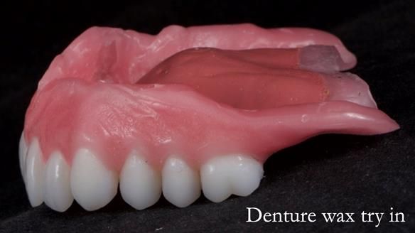 Newsletter 65 Marisa Provision of Complete Dentures on badly placed implants