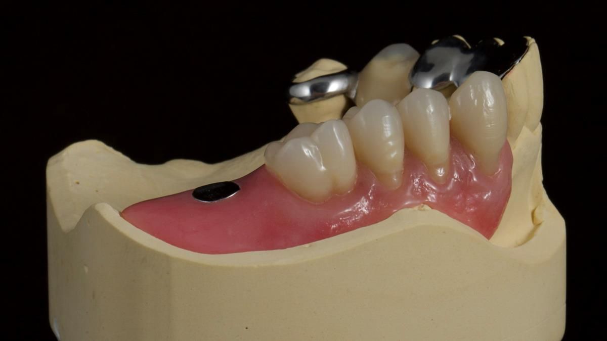 Newsletter 89 – Simon: A Challenging Kennedy Class II Division 1 Upper CoCr Partial Denture with a High Smile Line