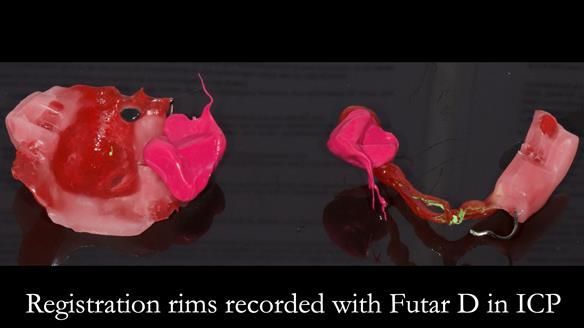 Newsletter 55 Provision of metal based partial dentures for Zephyrine with a repaired cleft lip and palate