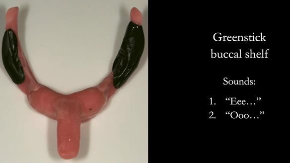 Greenstick right and left buccal shelves from canine to second molar position – avoid the retromolar pad – this is moulded in the patients mouth by the patient saying “EEE” and “OOO” with exaggerated cheek movements.
