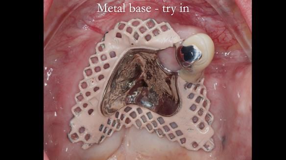 Newsletter 55 Provision of metal based partial dentures for Zephyrine with a repaired cleft lip and palate