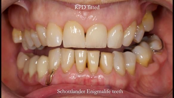 Finlay's Newsletter 61 provision of a lower unilateral free end saddle metal based partial denture for Joyce