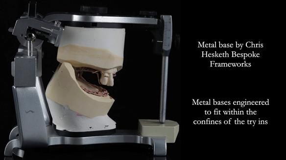 Finlay's Newsletter 59 Ultra hard partial dentures made for Gill