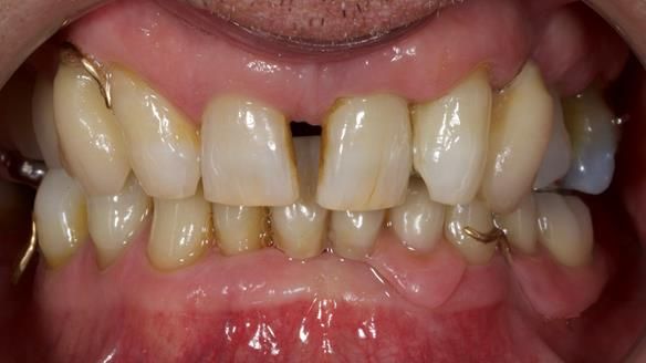 Newsletter 86 Peter the Architect — precision removable partial dentures case study