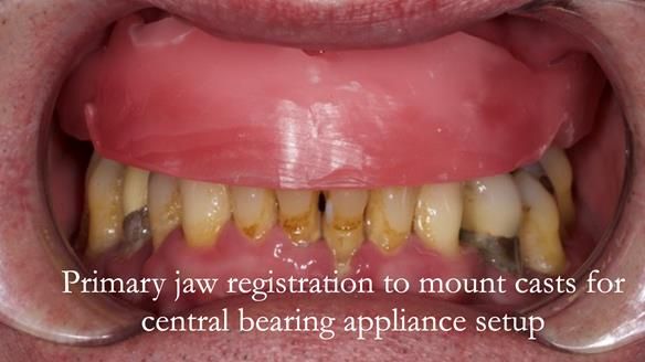 Newsletter 77: Jeremy’s case – immediate complete upper denture