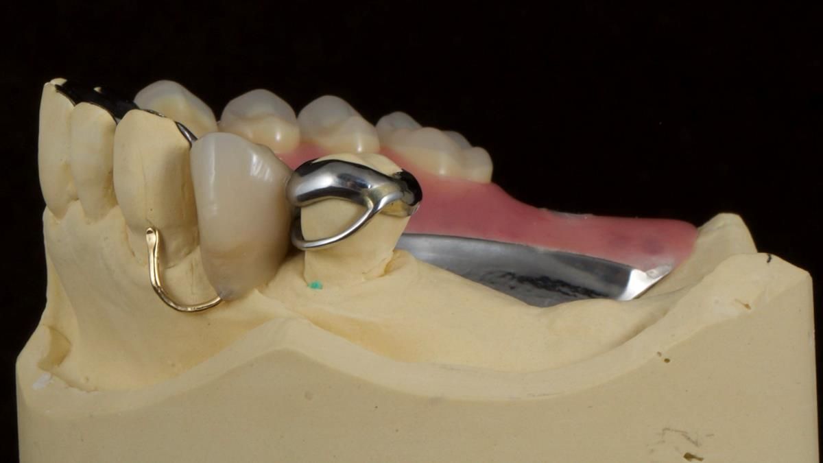Newsletter 89 – Simon: A Challenging Kennedy Class II Division 1 Upper CoCr Partial Denture with a High Smile Line