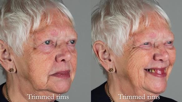 Finlay's Newsletter 59 Ultra hard partial dentures made for Gill