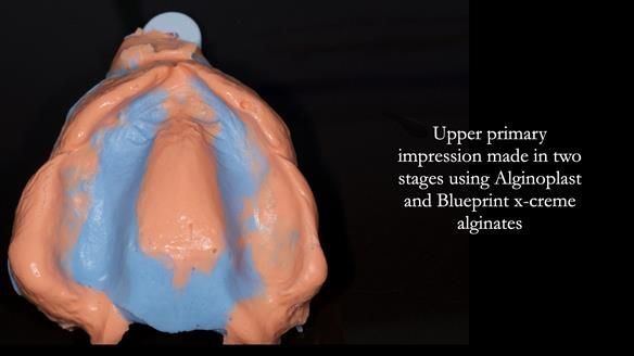 Newsletter 77: Jeremy’s case – immediate complete upper denture