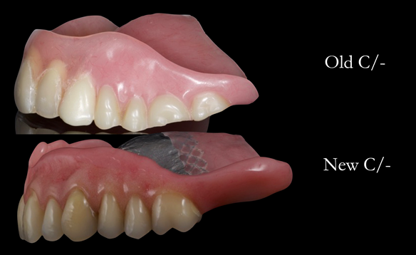 Newsletter 54 case presentation upper complete denture and lower Scandinavian designed hygienic partial denture for David