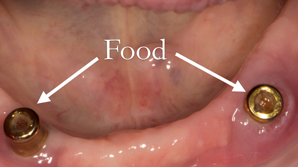 Figure 8 Food (particularly seeds) get pushed into the abutment centre resulting in the denture attachment not seating