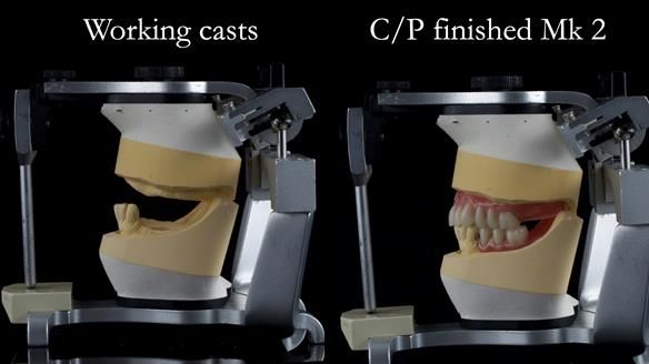 Newsletter 52 Managing Jo’s failing dentition with extractions and Mk 1/Mk 2 complete upper dentures and lower partial dentures FULL PROTOCOL