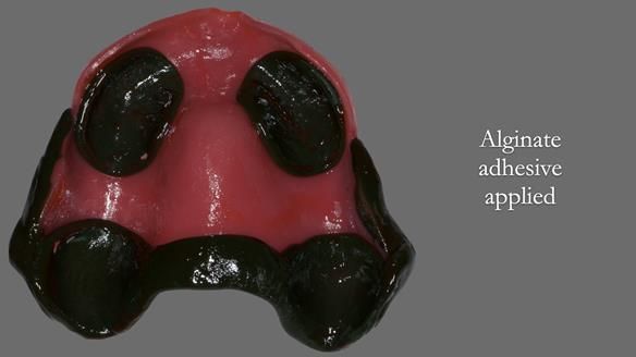 Finlay's Newsletter 62 provision of extractions and metal based complete dentures for Rafique