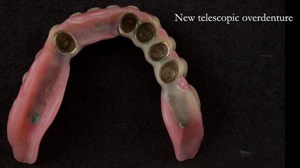 Newsletter 76: Jackie’s case – Telescopic overdenture & precision RPD (the tricky truth!)