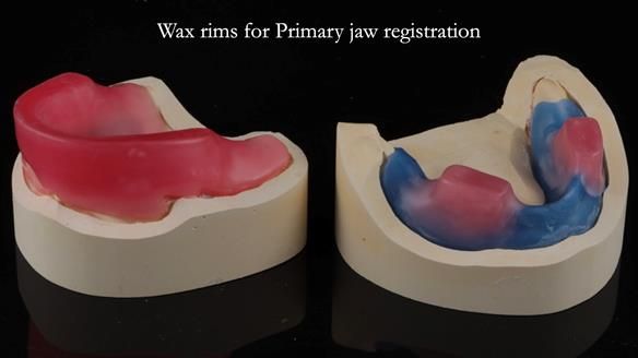 Finlay's Newsletter 62 provision of extractions and metal based complete dentures for Rafique