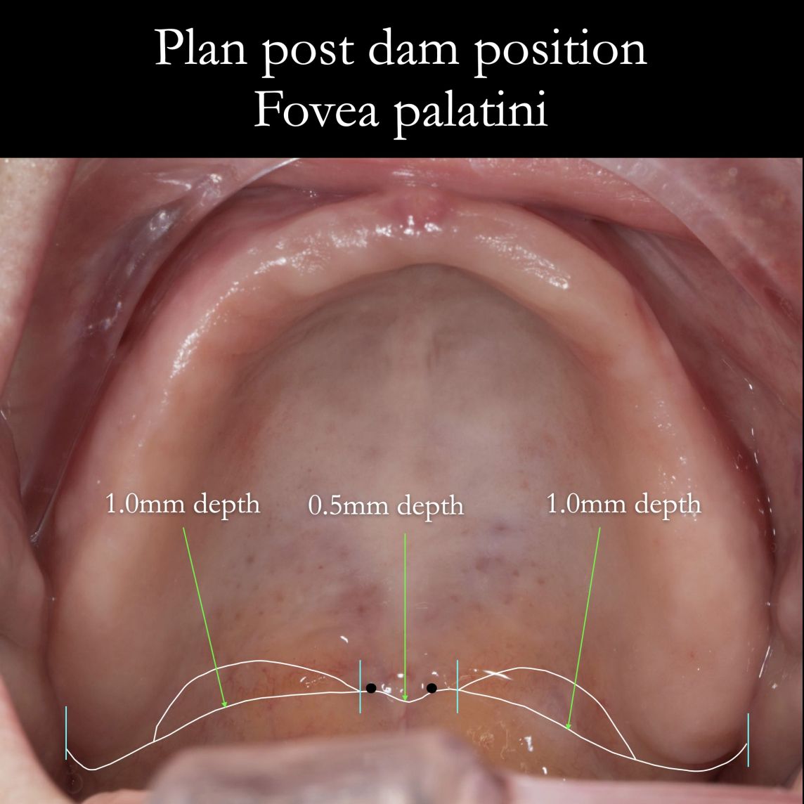 Post dam position for maxillary complete dentures – the fovea palatini getting a good posterior seal