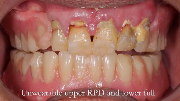 Finlay's Newsletter 62 provision of extractions and metal based complete dentures for Rafique