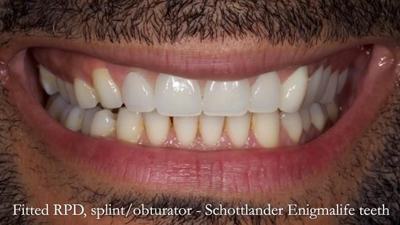 Upper metal base partial denture/occlusal stabilisation splint/obturator - full protocol