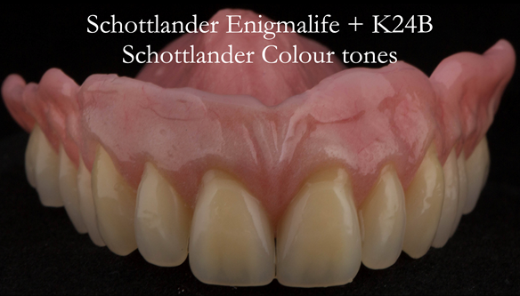 Figure 30 Finished upper immediate denture. Optimal extension of flanges via the 2 part impression process - figures 14 - 20