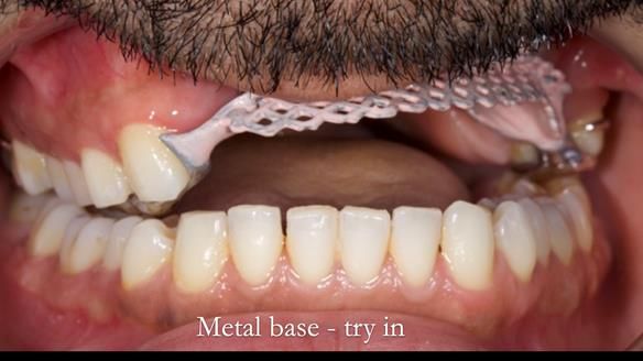 Upper metal base partial denture/occlusal stabilisation splint/obturator - full protocol