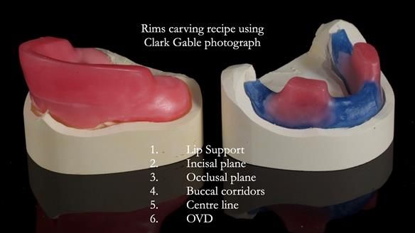 Newsletter 78: What do Clark Gable and a Locator® overdenture have in common?