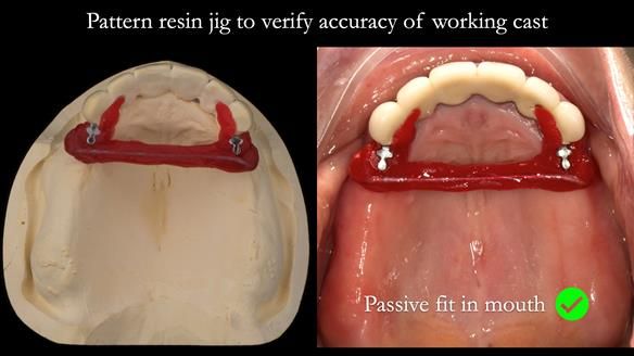 Newsletter 76: Jackie’s case – Telescopic overdenture & precision RPD (the tricky truth!)