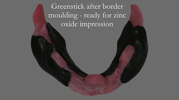 Finlay's Newsletter 62 provision of extractions and metal based complete dentures for Rafique