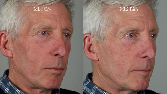 Newsletter 77: Jeremy’s case – immediate complete upper denture