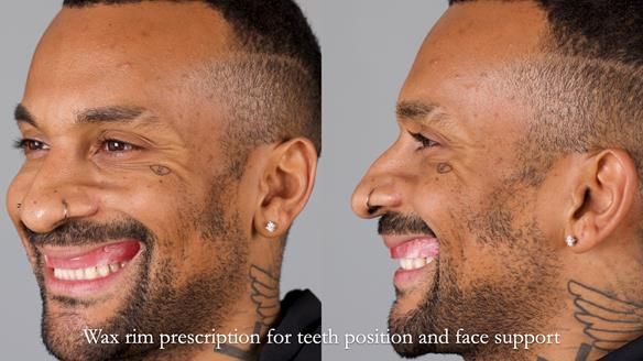 Upper metal base partial denture/occlusal stabilisation splint/obturator - full protocol