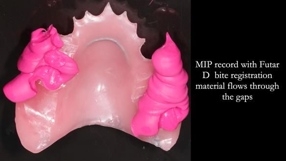 Newsletter 56 showing the making and fitting of a bilateral free end saddle upper removable partial denture (RPD) for patient with pemphigus