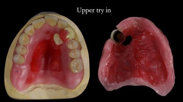 Newsletter 55 Provision of metal based partial dentures for Zephyrine with a repaired cleft lip and palate